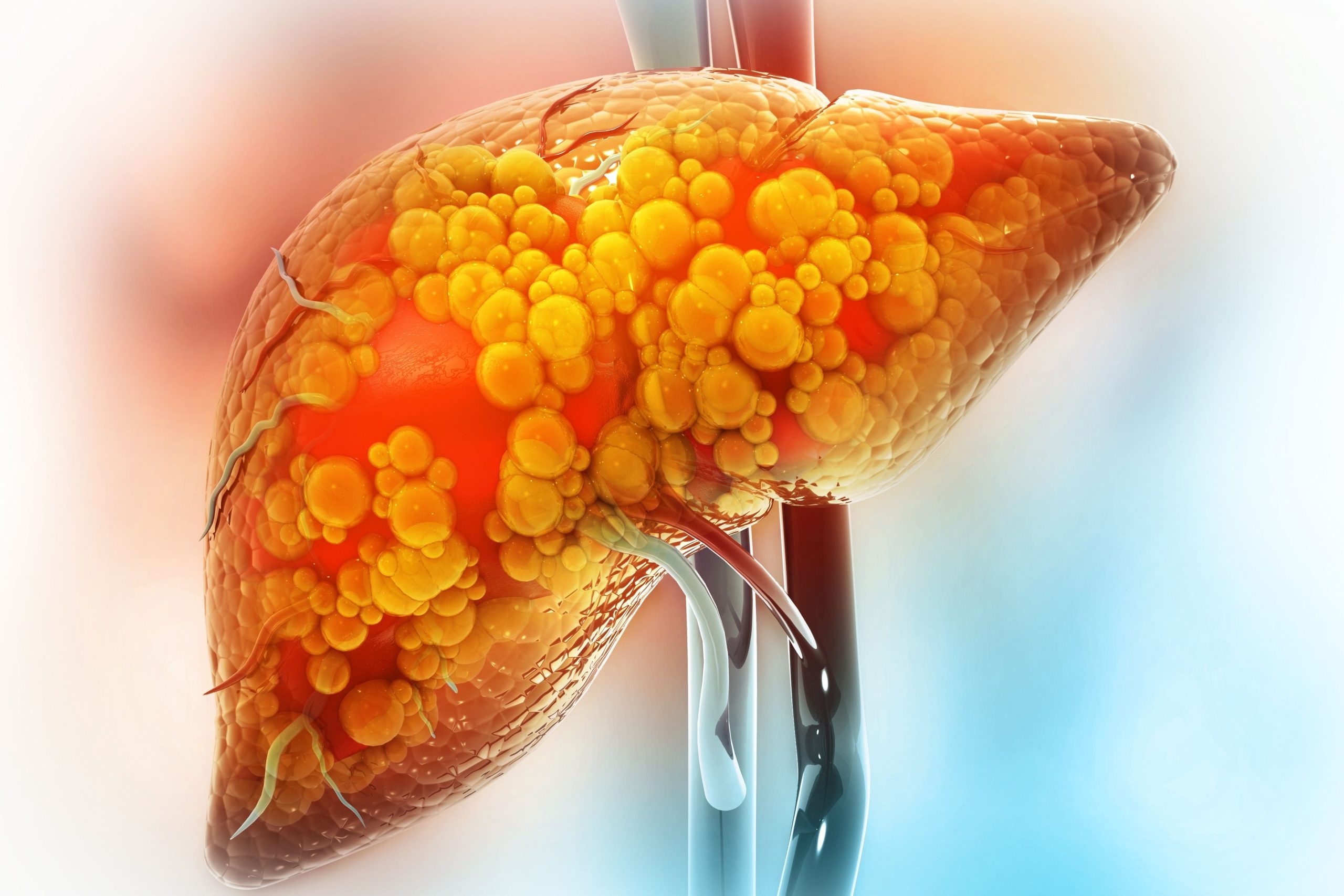 Fatty Liver LexiMed